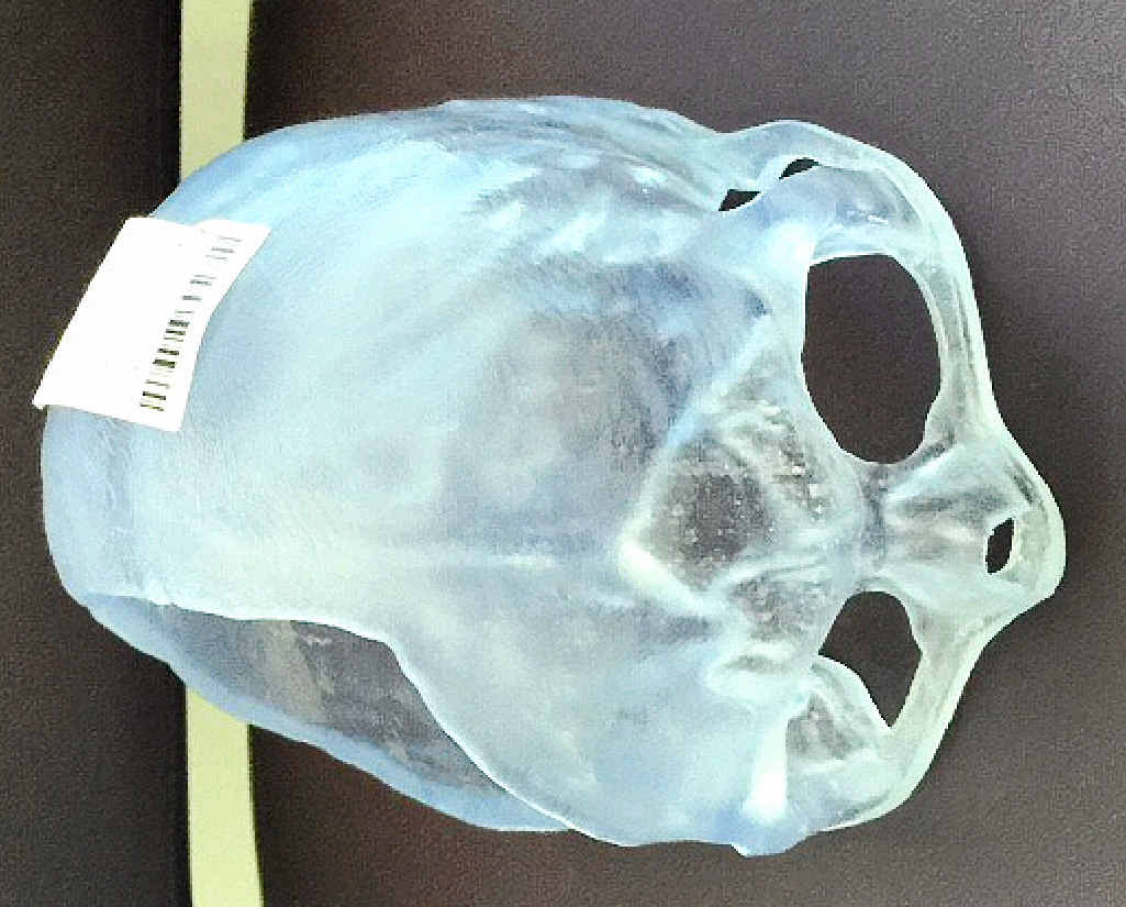 Mr Espley’s new acrylic skull plate has returned his head to a normal shape. Mr Espley’s new acrylic skull plate has returned his head to a normal shape.
